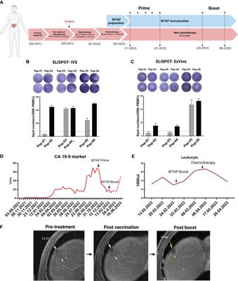 Individualized neoantigen peptide immunization of a metastatic pancreatic cancer patient: a case report of combined tumor and liquid biopsy